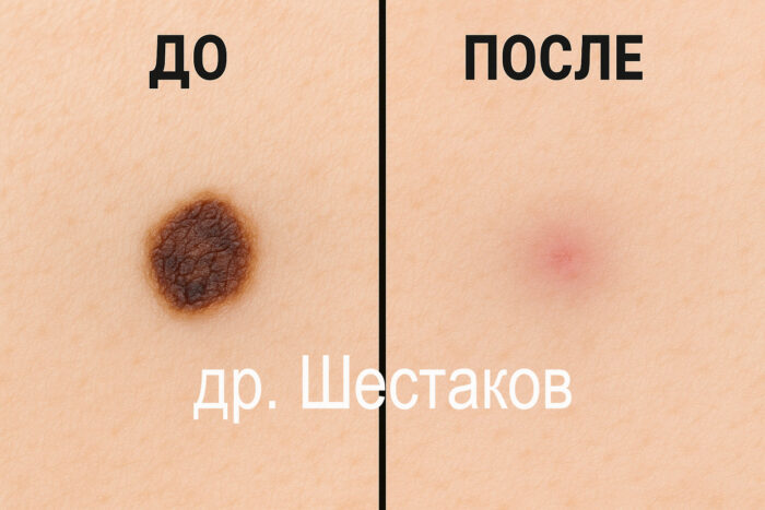Радиоволновое удаление родинок недостатки и преимущества