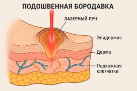 Удаление бородавок лазером в Строгино