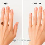 Удаление новообразований на коже
