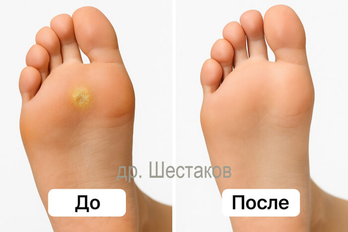 Удаление подошвенных бородавок