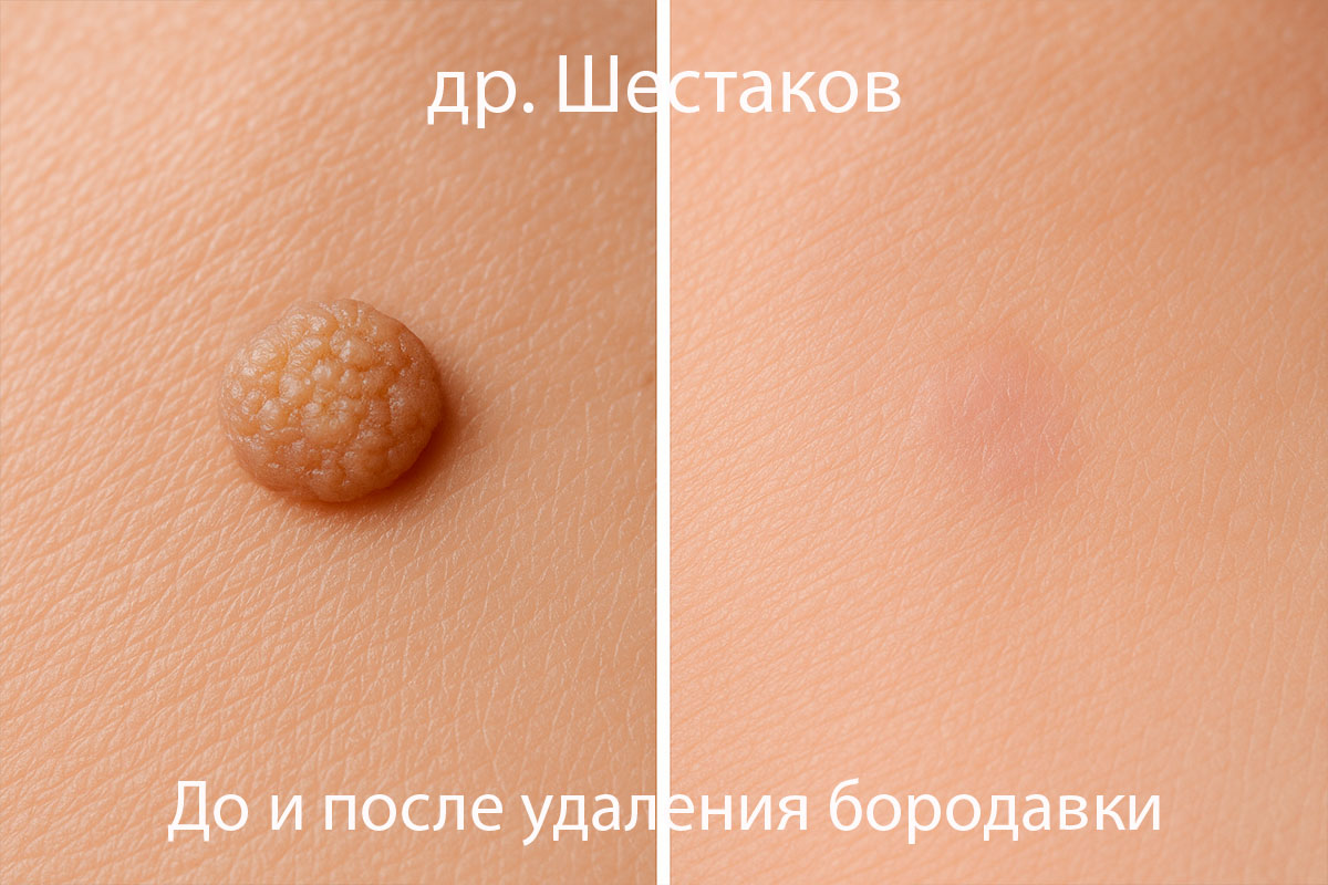 Можно ли срезать бородавку