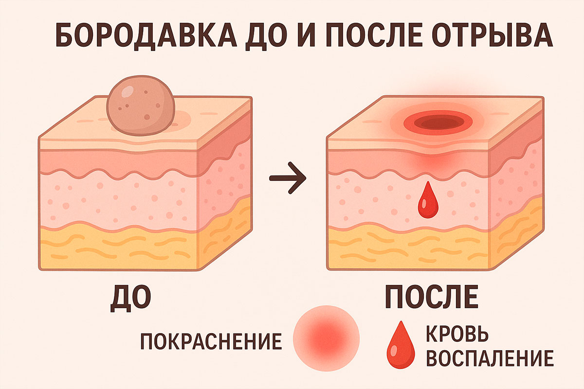 Можно ли срезать бородавку