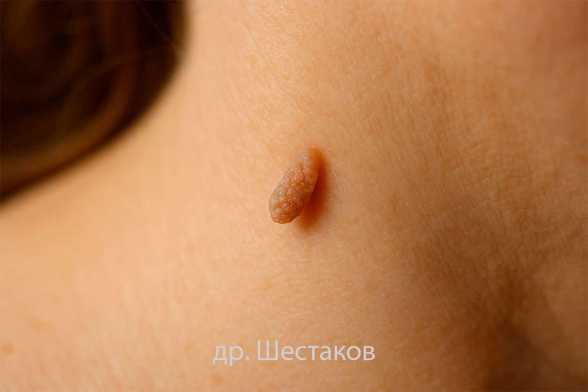 Папиллома это