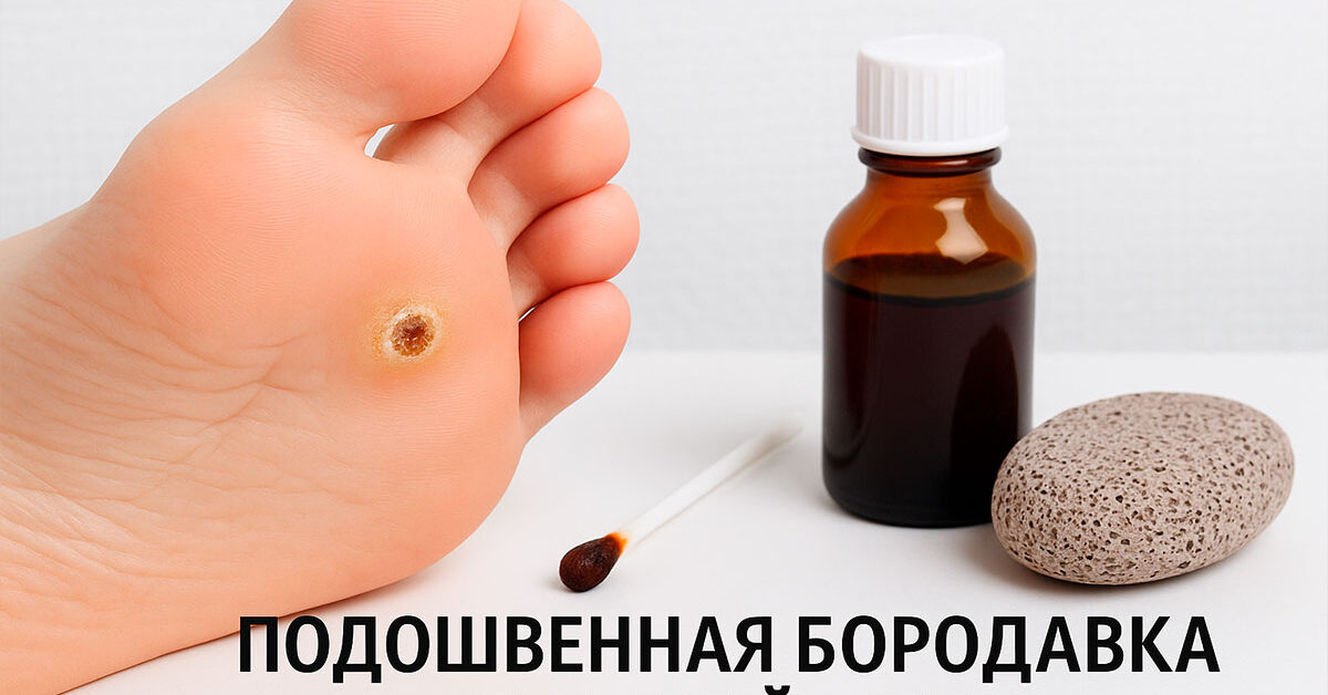 Подошвенная бородавка лечение йодом