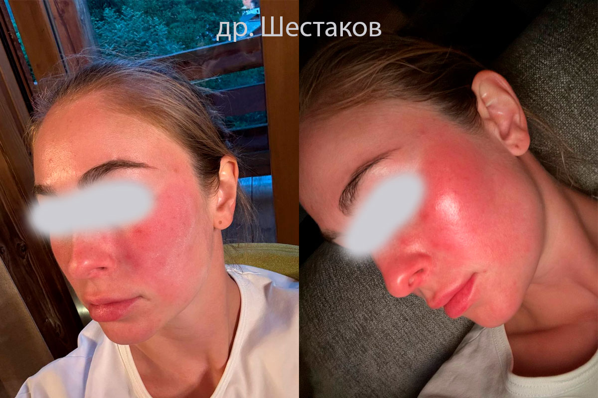 Розацеа в поездке