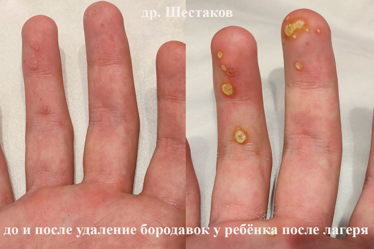 Удаление бородавок у ребёнка после лагеря