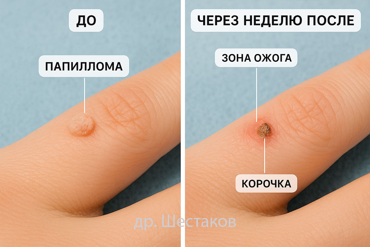 Удаление папиллом уксусной эссенцией