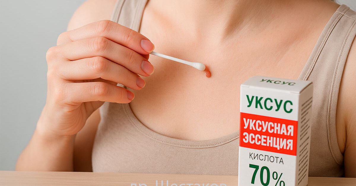 Удаление папиллом уксусной эссенцией