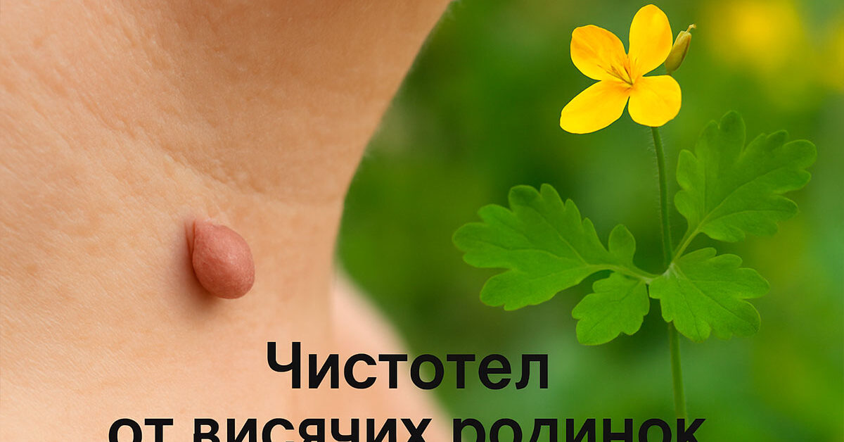 Чистотел от висячих родинок
