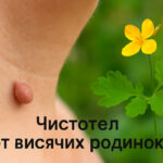Чистотел от висячих родинок