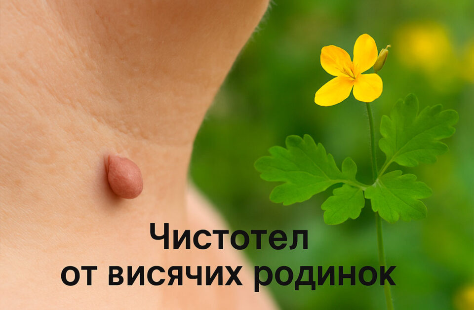 Чистотел от висячих родинок