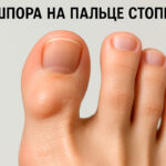 Шпора на пальце ноги