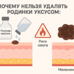 Удаление родинки яблочным уксусом