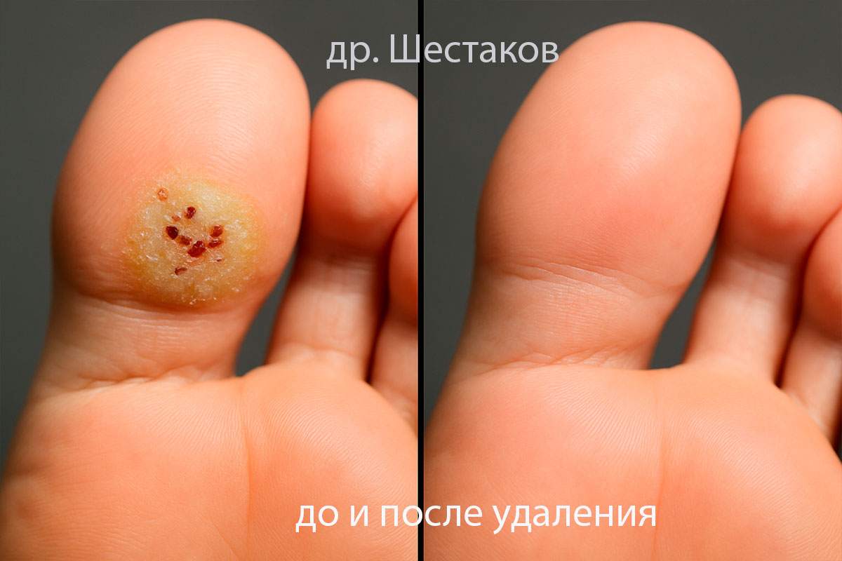 Удаление шипицы