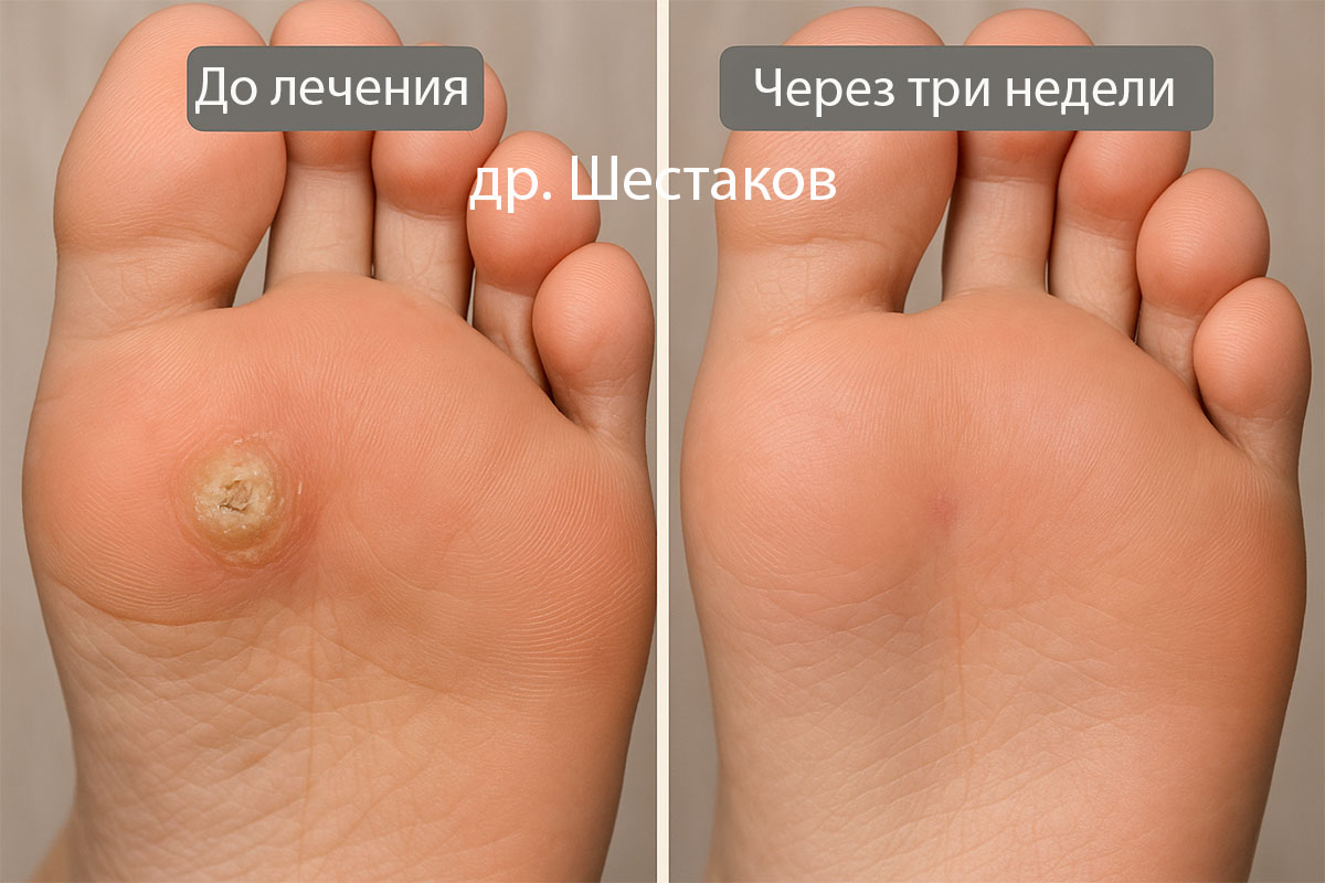 Заразны ли бородавки