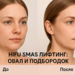 Hifu smas лифтинг лица