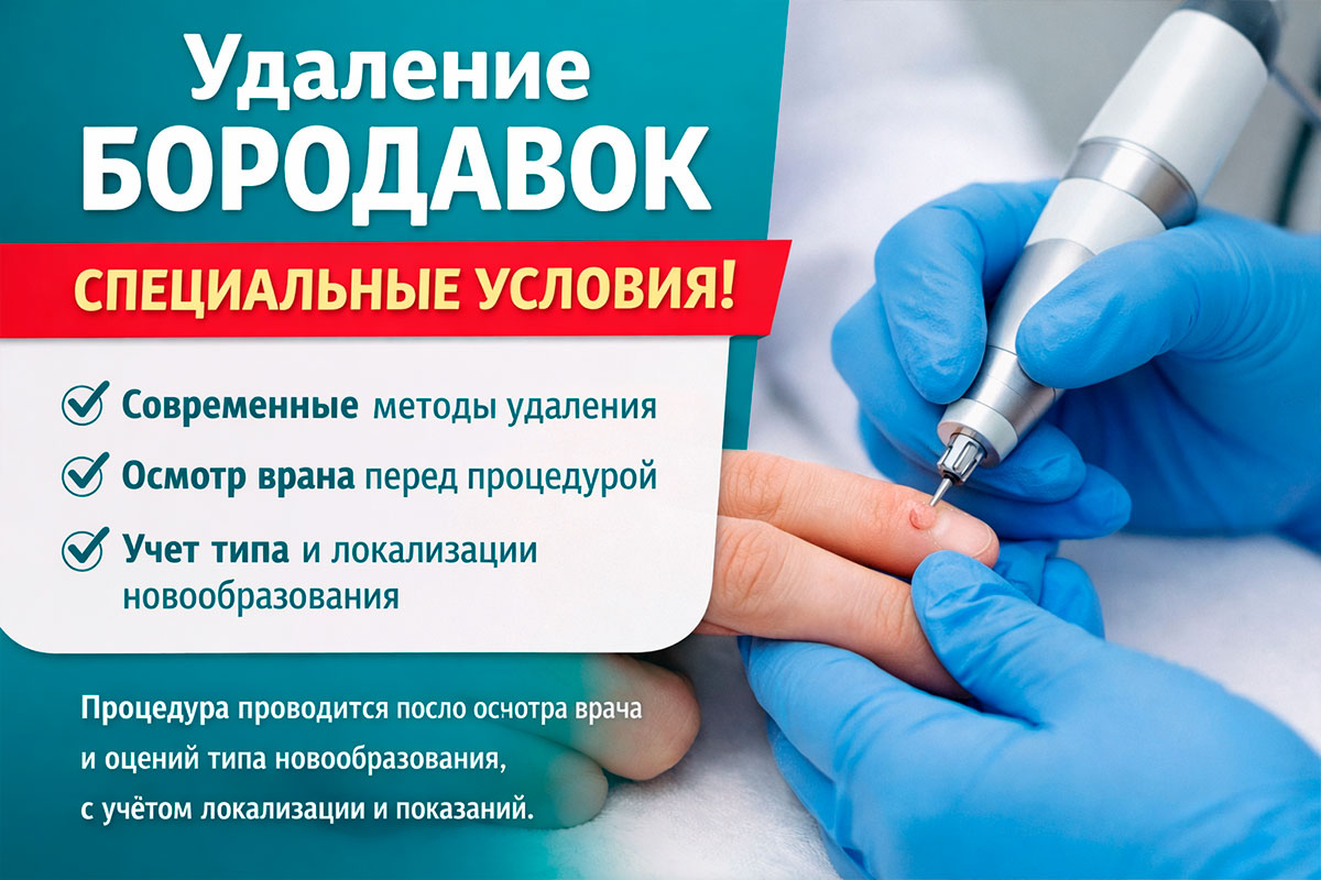 Удаление бородавок