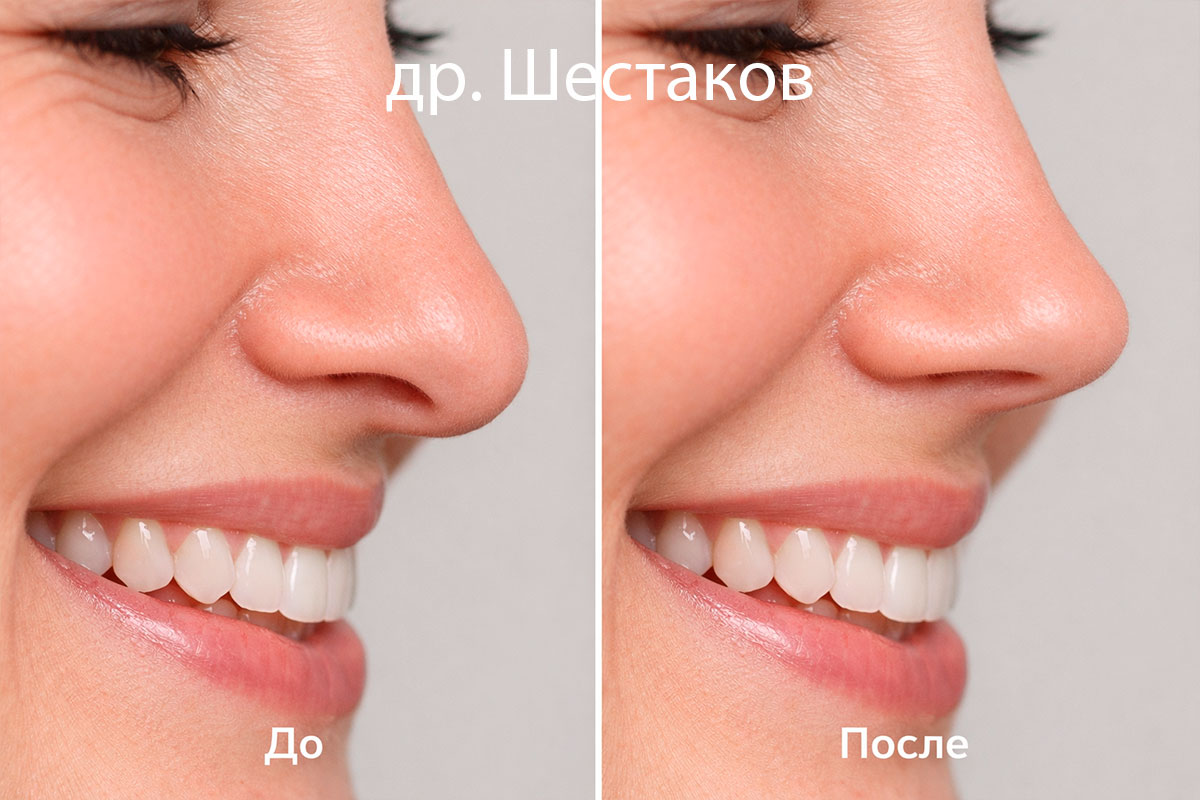 Ботулинотерапия носа: как смягчить мимику и улучшить гармонию лица