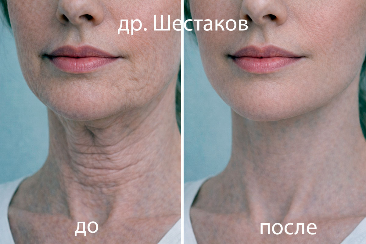 Ботулинотерапия подбородка