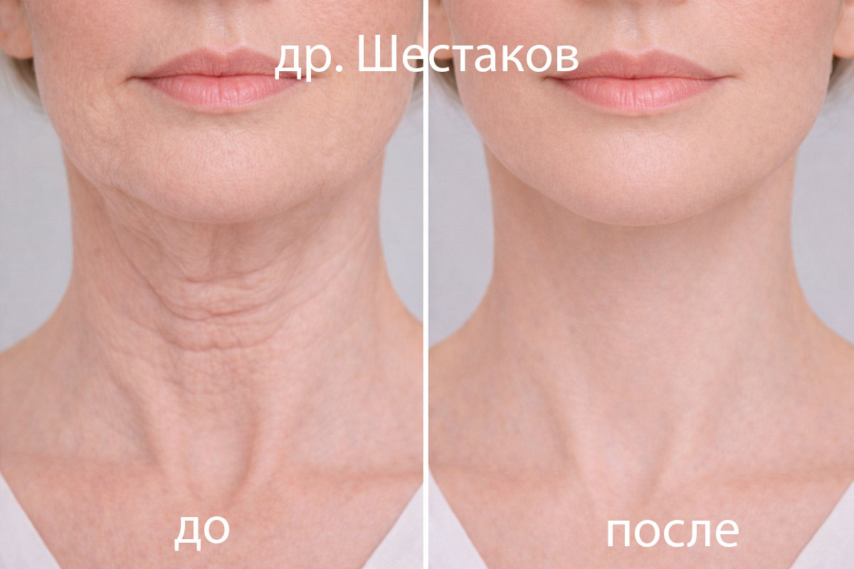 Ботулинотерапия подбородка