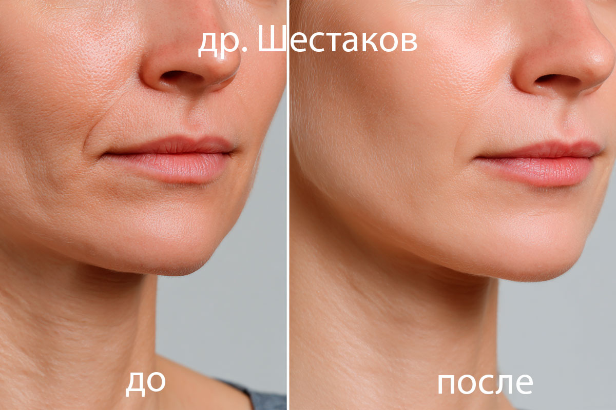 Ботулинотерапия подбородка