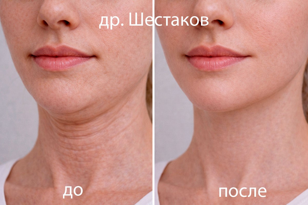 Ботулинотерапия подбородка