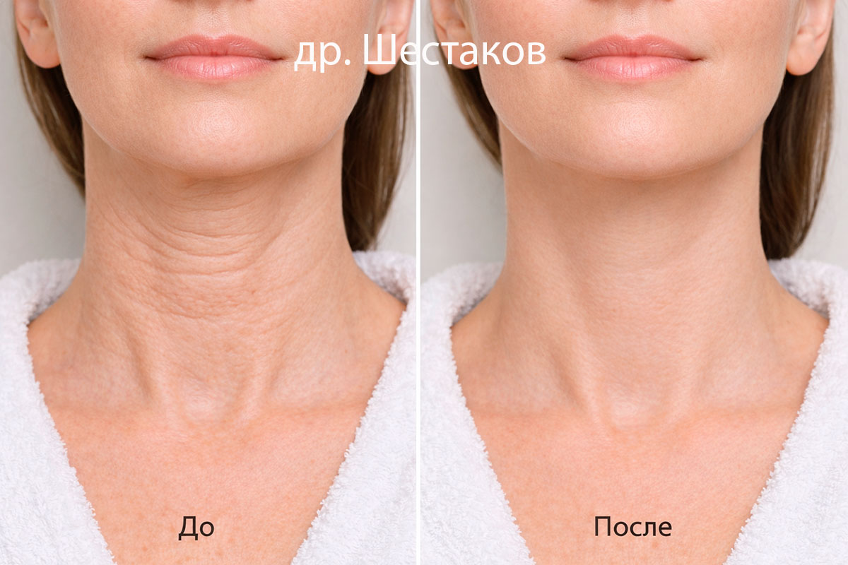 Ботулинотерапия шеи
