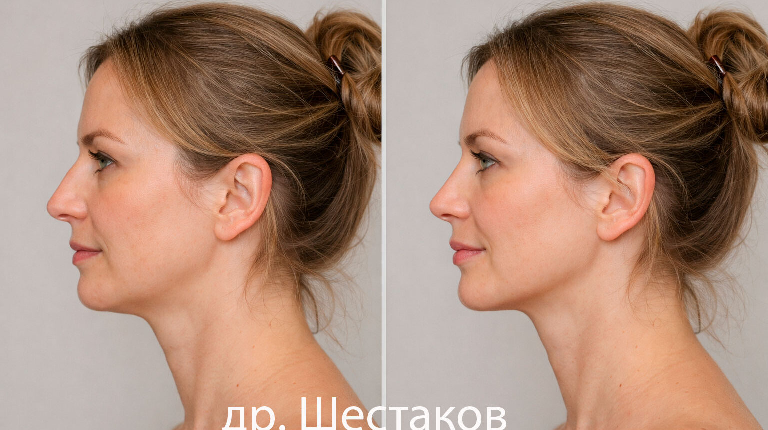 Контурная пластика подбородка