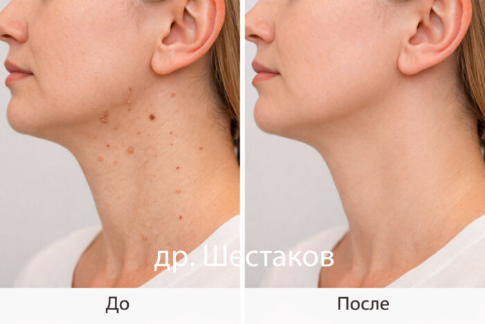 Фото до и после удаления папиллом в нейтральной подаче (одинаковый ракурс и освещение)