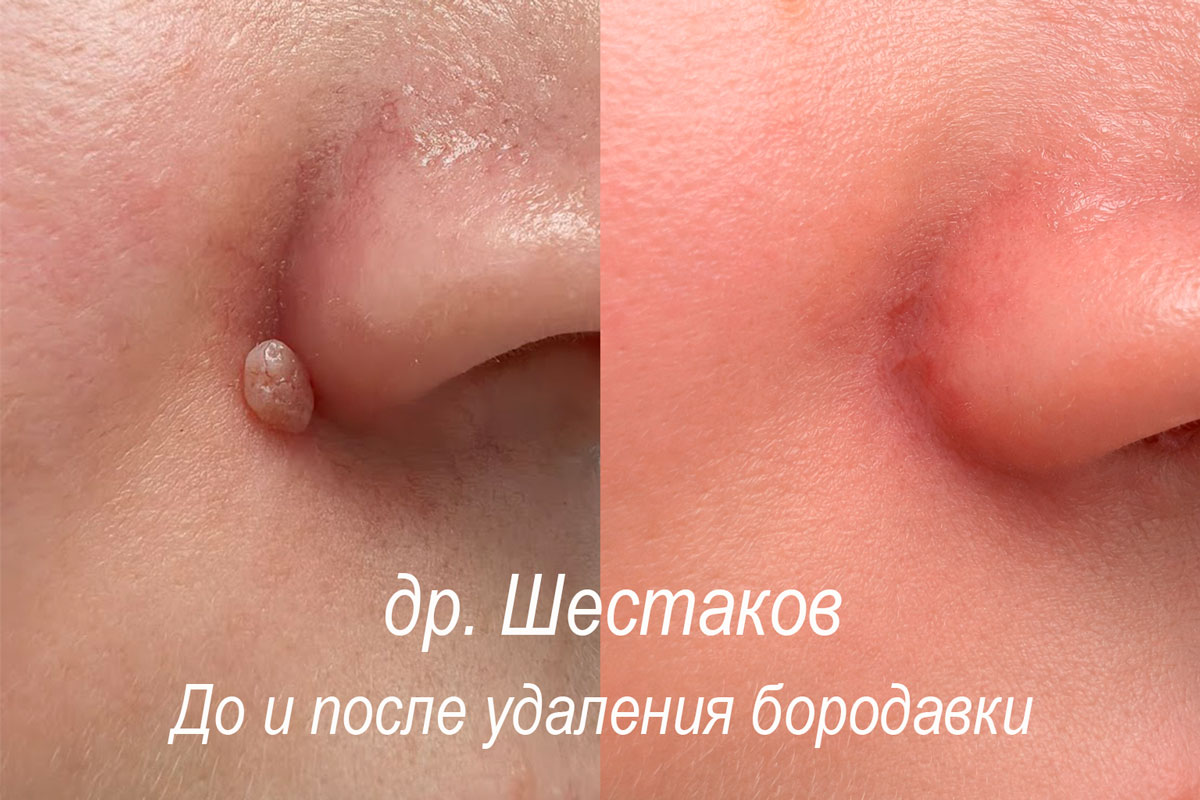 Фото до и после удаление бородавок