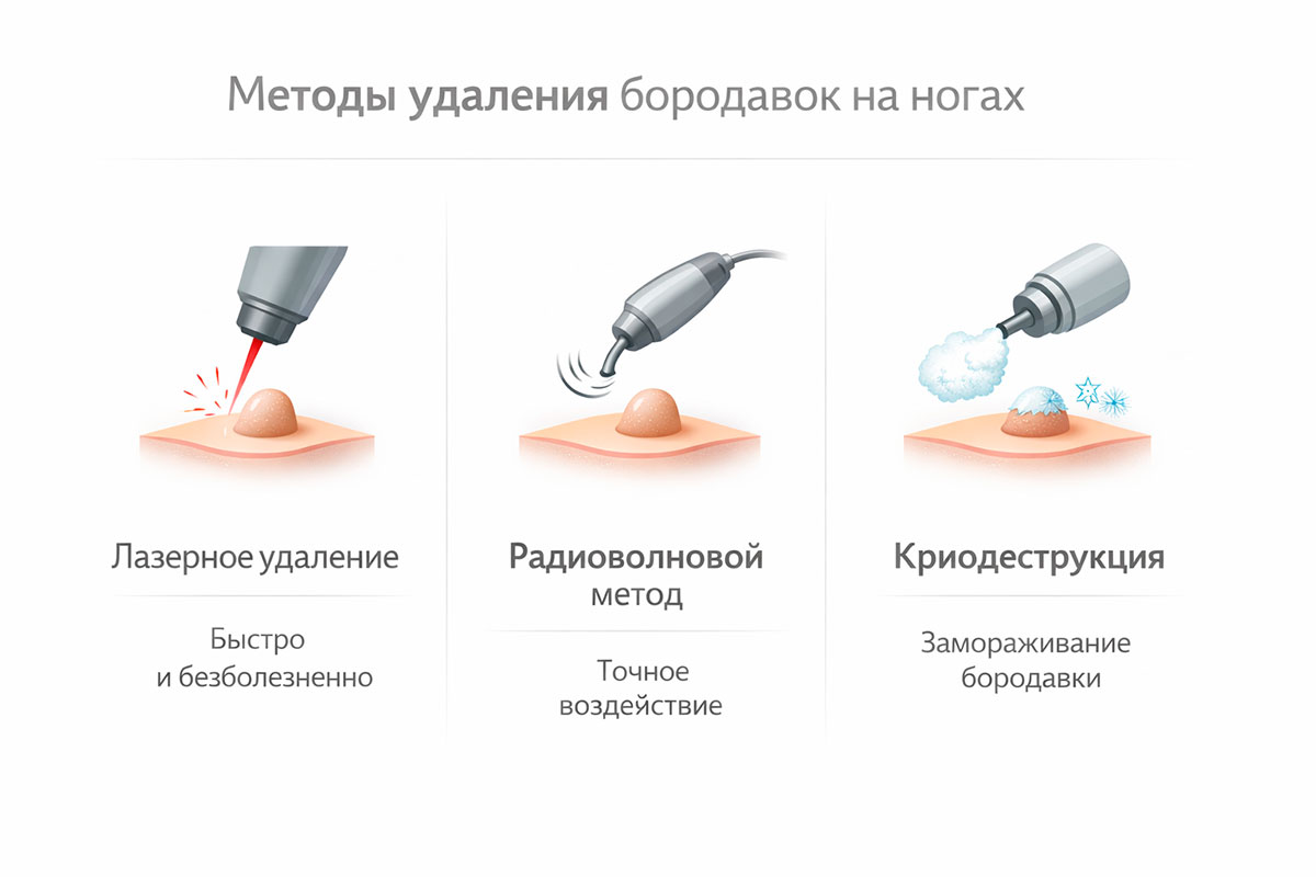 Инфографика методов удаления бородавок на ногах: лазер, радиоволновой метод и криодеструкция