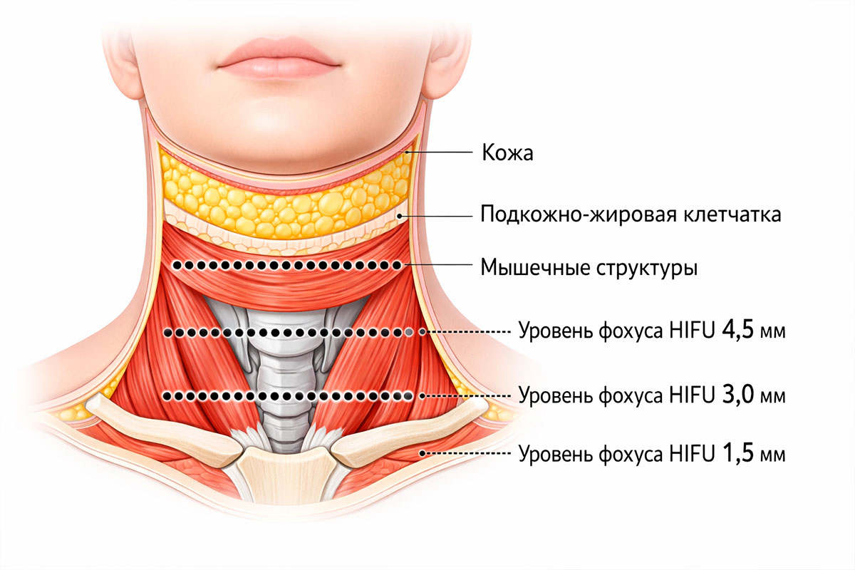 Схема слоёв шеи и глубин воздействия HIFU при SMAS-лифтинге