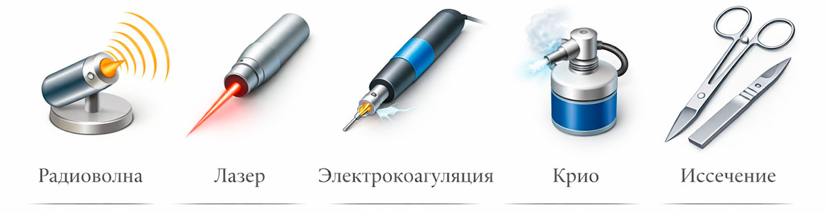 Методы удаления аногенитальных кондилом: радиоволна, лазер, коагуляция, крио, иссечение