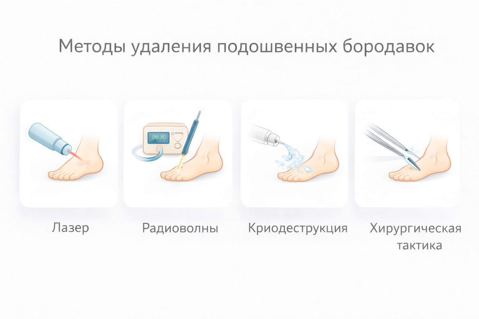 Инфографика методов удаления подошвенных бородавок: лазер, радиоволны, криодеструкция и хирургическая тактика