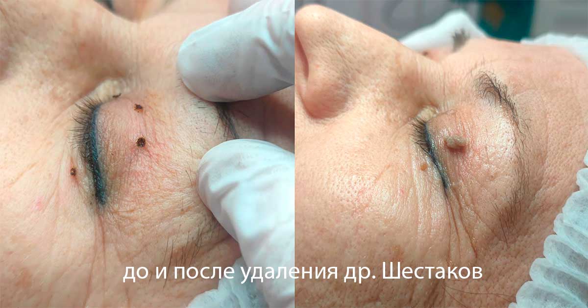 Как избавиться от бородавок